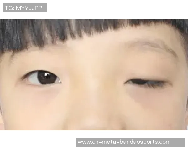 西媒揭示赫伊森眼睛难以睁开的原因是先天性眼睑下垂但不影响视力 西媒揭示赫伊森眼睛难以睁开的原因是先天性眼睑下垂但不影响视力